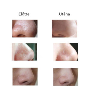 Vákuumos pórustisztító eszköz - mitesszer és pattanáseltávolító cserélhető fejekkel HQ-1875 (BBV) - Image 4