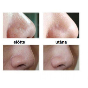 Vákuumos pattanás- és mitesszereltávolító / pórustisztító készülék HL-308 (BBM) - Image 6